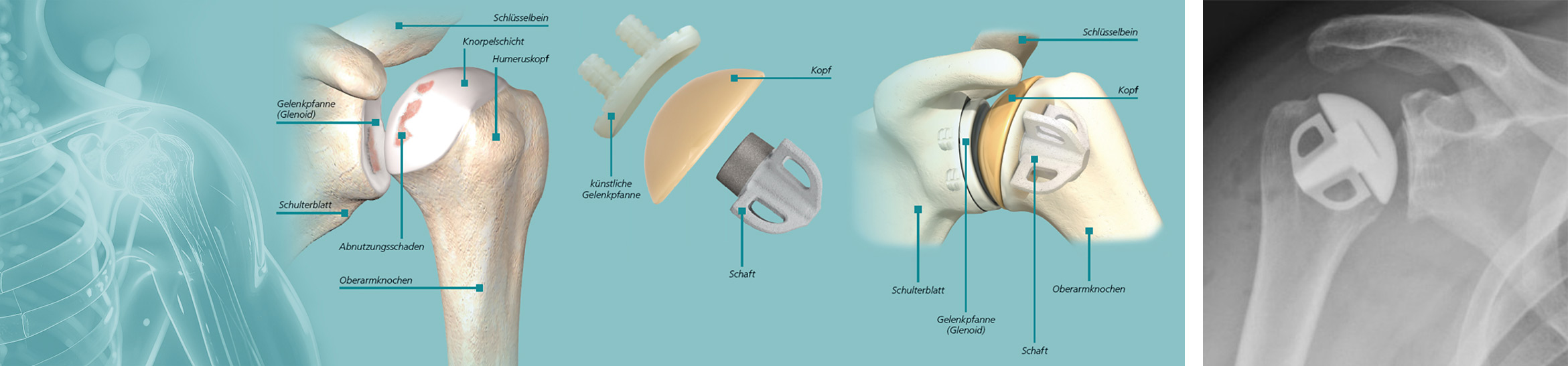 Anatomische Schulterprothese
